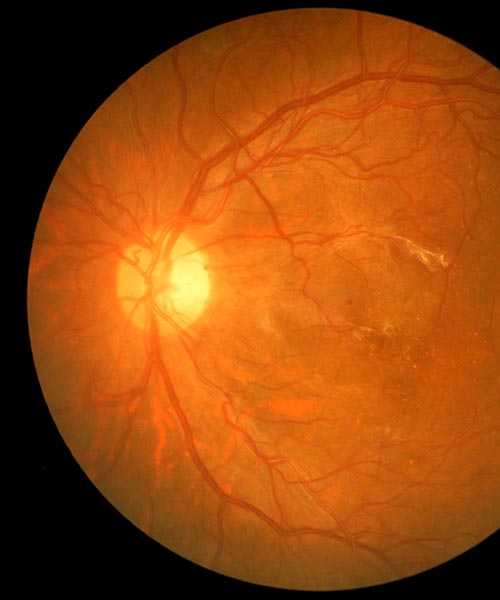retinografia